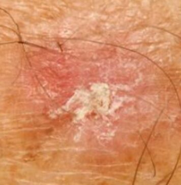 ఆక్టినిక్ కెరాటోసిస్: కారణాలు, లక్షణాలు మరియు చికిత్స Actinic keratosis