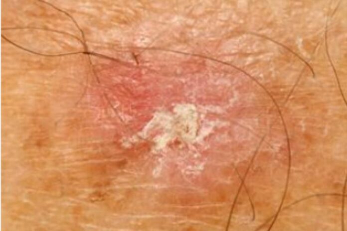 Actinic keratosis Actinic keratosis