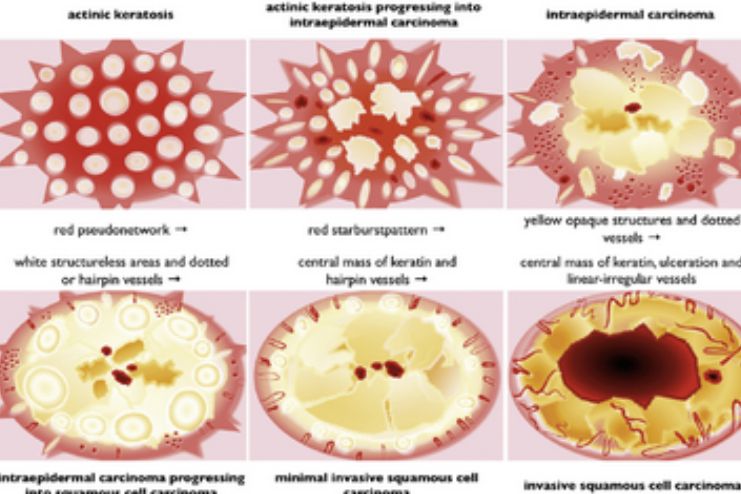 Actinic keratosis C