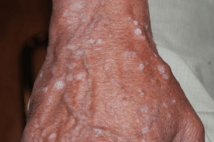 Actinic keratosis Causes