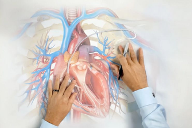 Can hypertrophic cardiomyopathy change over time