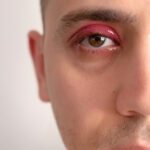 Causes-of-Styes