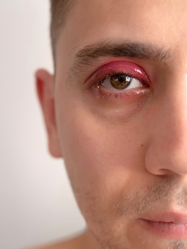 కళ్ళ అపరిశుభ్రతే స్టైలకు కారణమా?