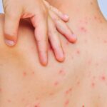 Chickenpox outbreak in summer