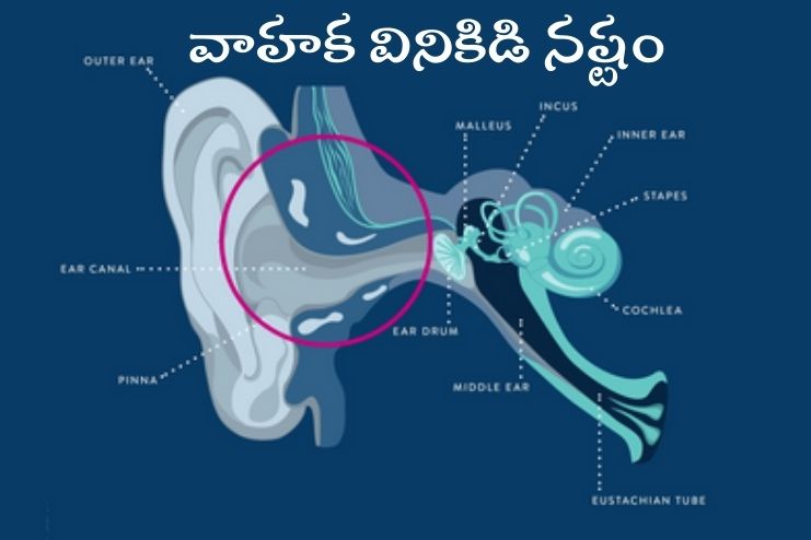 Conductive hearing loss