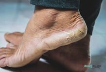 పగిలిన మడమలు: కారణాలు, చికిత్స మరియు నివారణ Cracked Heels_ Causes, Treatment, and Prevention