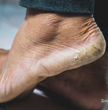 పగిలిన మడమలు: కారణాలు, చికిత్స మరియు నివారణ Cracked Heels_ Causes, Treatment, and Prevention