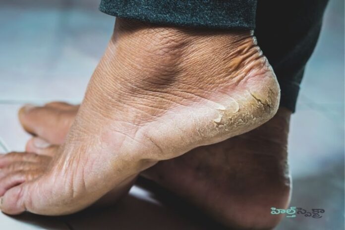 Cracked Heels_ Causes, Treatment, and Prevention