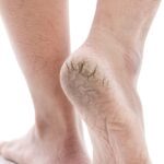 Cracked heels