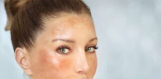 వేసవిలో హైపర్పిగ్మెంటేషన్ నిర్వహణ ఇలా.! - Effective Strategies for Summer Hyper-pigmentation Effective Strategies for Summer Hyper-pigmentation