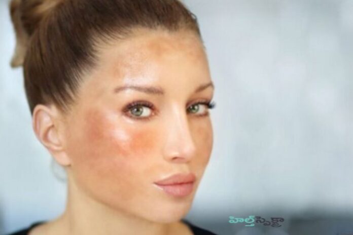 Effective Strategies for Summer Hyper-pigmentation