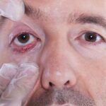 External versus Internal Stye