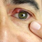 Eye stye