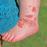 Hand, foot and mouth disease HFMD