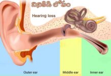 వినికిడి లోపం: కారణాలు, లక్షణాలు మరియు చికిత్స Hearing Loss_ Causes, Symptoms and Treatment