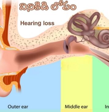 వినికిడి లోపం: కారణాలు, లక్షణాలు మరియు చికిత్స Hearing Loss_ Causes, Symptoms and Treatment