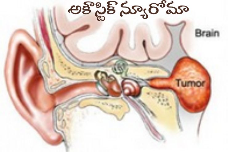 Hearing loss and acoustic neuroma 2