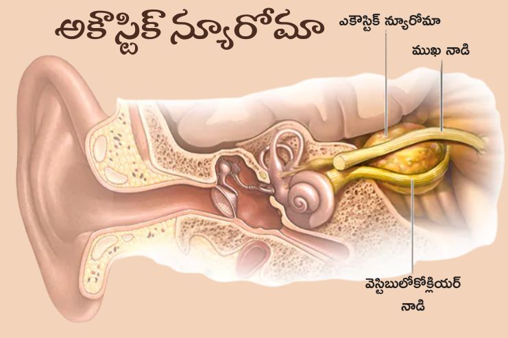 Hearing loss and acoustic neuroma