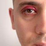 Hidden Causes of Styes