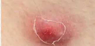 హైడ్రాడెనిటిస్ సప్పురాటివా: కారణాలు, లక్షణాలు మరియు చికిత్స - Hidradenitis suppurativa: Causes, Symptoms and Treatment Hidradenitis suppurativa