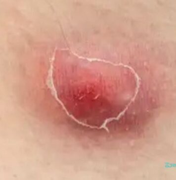 హైడ్రాడెనిటిస్ సప్పురాటివా: కారణాలు, లక్షణాలు మరియు చికిత్స Hidradenitis suppurativa