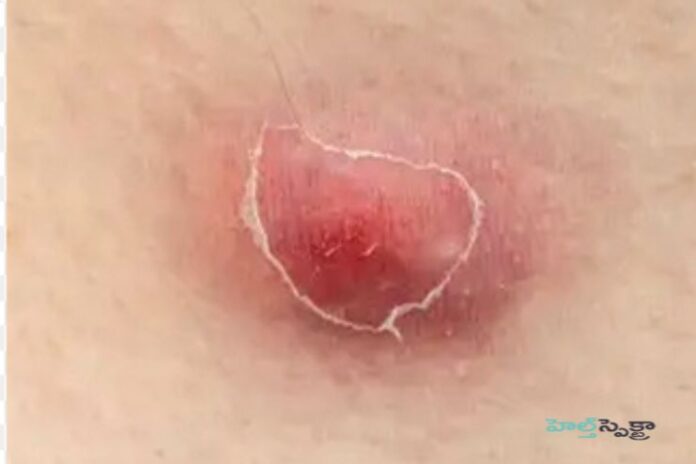 Hidradenitis suppurativa