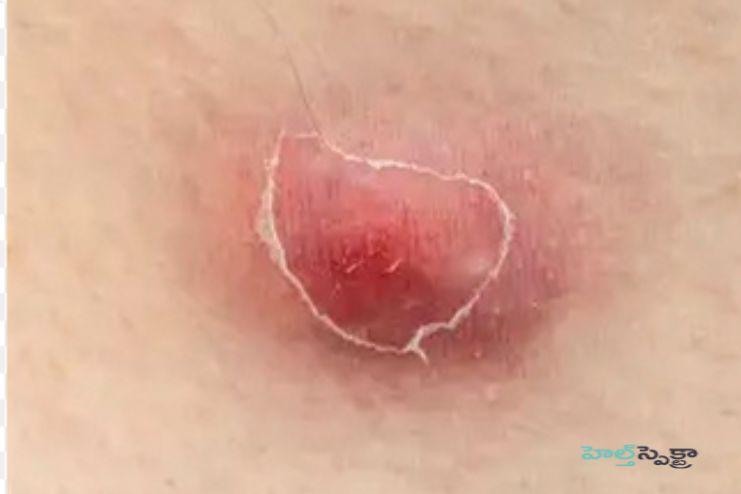 హైడ్రాడెనిటిస్ సప్పురాటివా: కారణాలు, లక్షణాలు మరియు చికిత్స - <span class='sndtitle'></img>Hidradenitis suppurativa: Causes, Symptoms and Treatment </span>