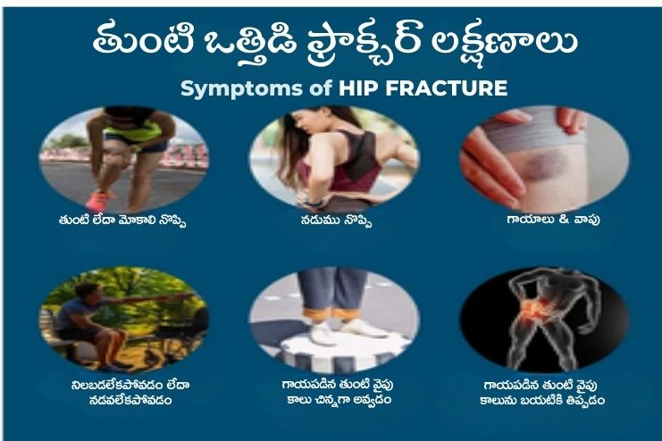 Hip Stress Fracture Symptoms