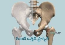తుంటి ఒత్తిడి ఫ్రాక్చర్: లక్షణాలు, కారణాలు మరియు చికిత్స Hip Stress Fracture_ Symptoms, Causes, and Treatment