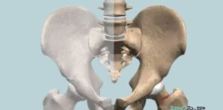 Hip Stress Fracture_ Symptoms, Causes, and Treatment