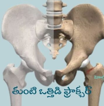 తుంటి ఒత్తిడి ఫ్రాక్చర్: లక్షణాలు, కారణాలు మరియు చికిత్స Hip Stress Fracture_ Symptoms, Causes, and Treatment