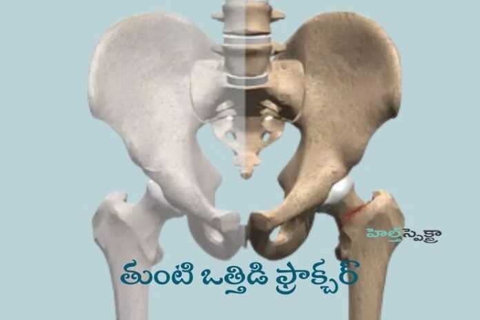 Hip Stress Fracture_ Symptoms, Causes, and Treatment