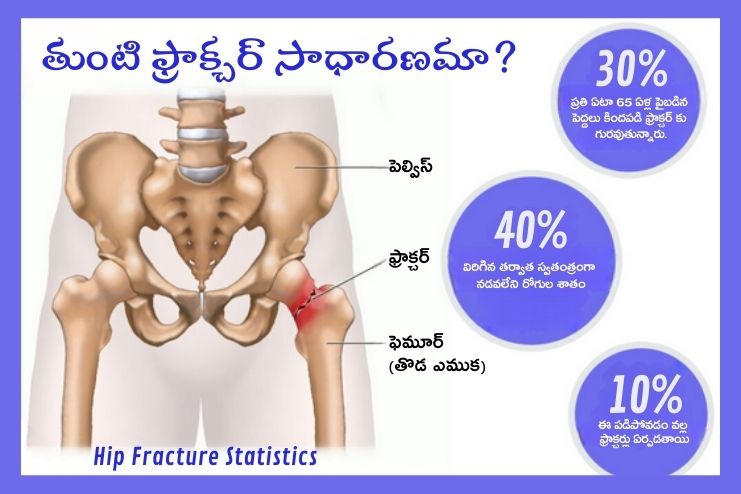 How Common is Hip Fractures