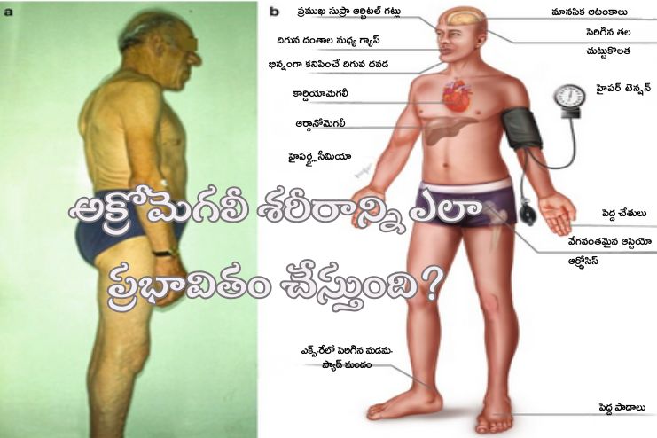 How does acromegaly affect the body