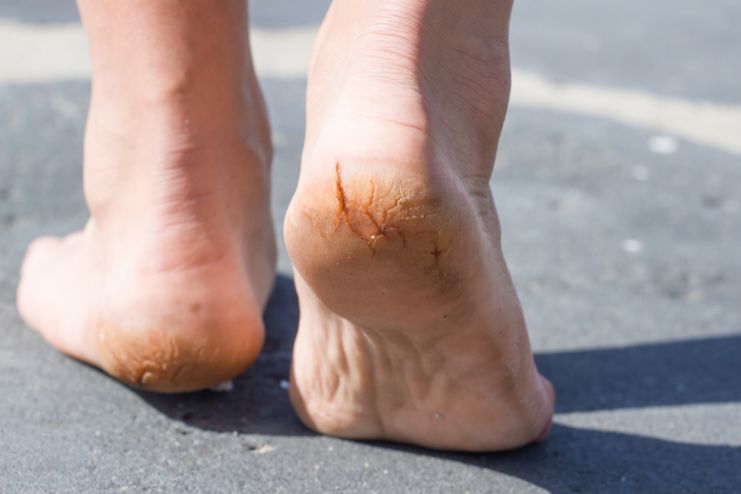How to Treat Cracked Heels at Home