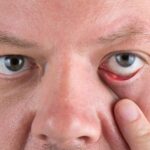 Internal stye