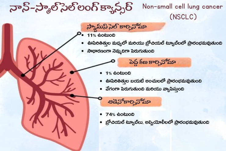 Non-small cell lung cancer (NSCLC)