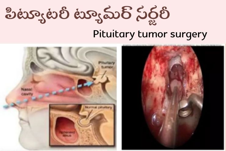 Pituitary tumor surgery