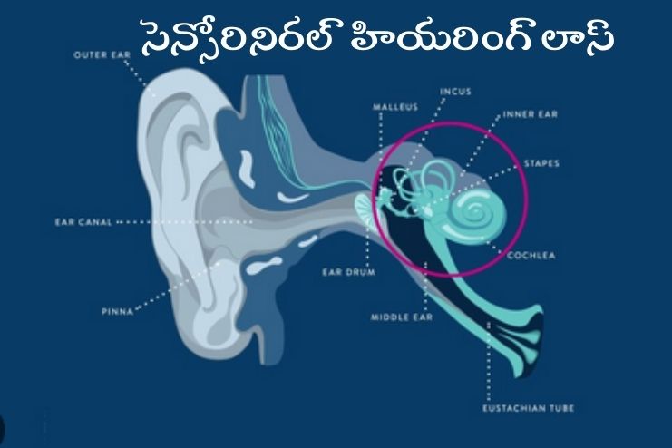 Sensorineural hearing loss