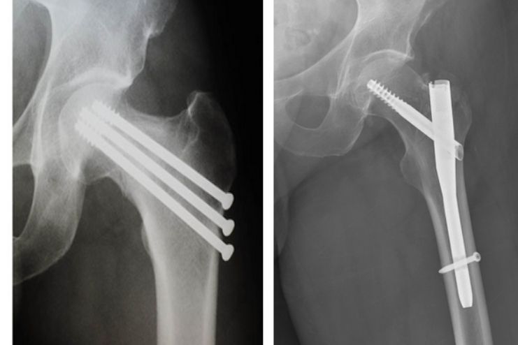 Surgery for Hip Stress Fractures