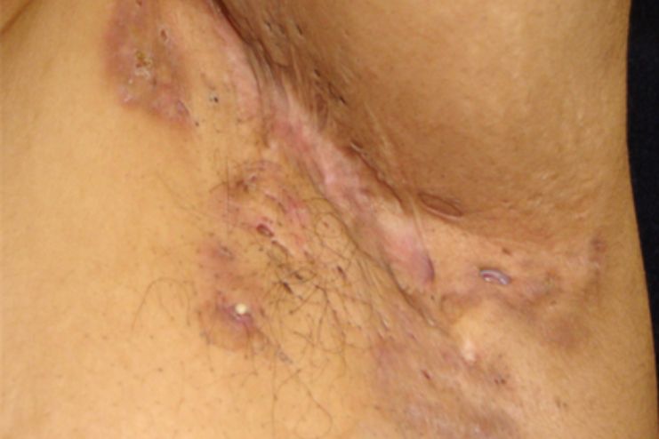 Surgery or other procedures