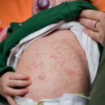 The danger of measles lurking in summer