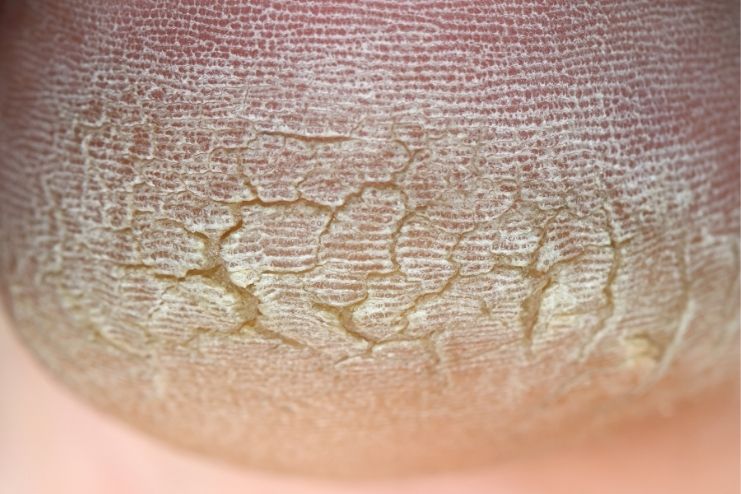 What are Cracked Heels