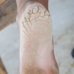 What are cracked heels