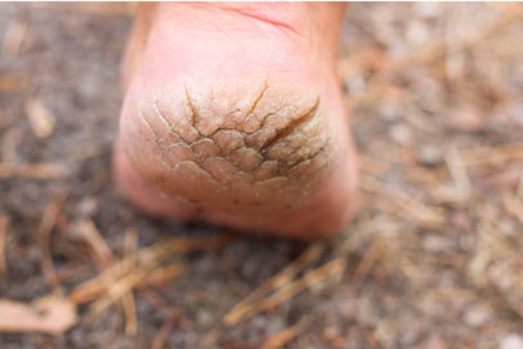 What happens if cracked heels are ignored