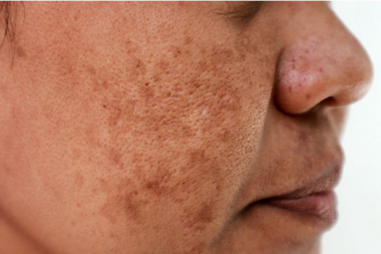 What is Hyperpigmentation