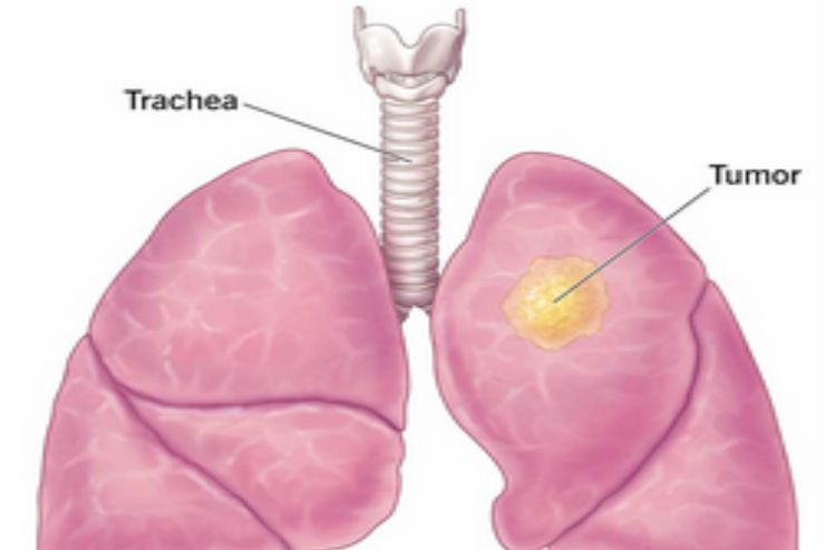 When Does Lung Cancer Begin