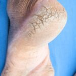 Why are heel cracks painful