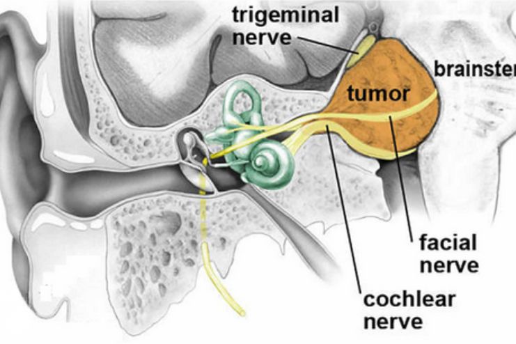 can acoustic neuroma shrink naturally