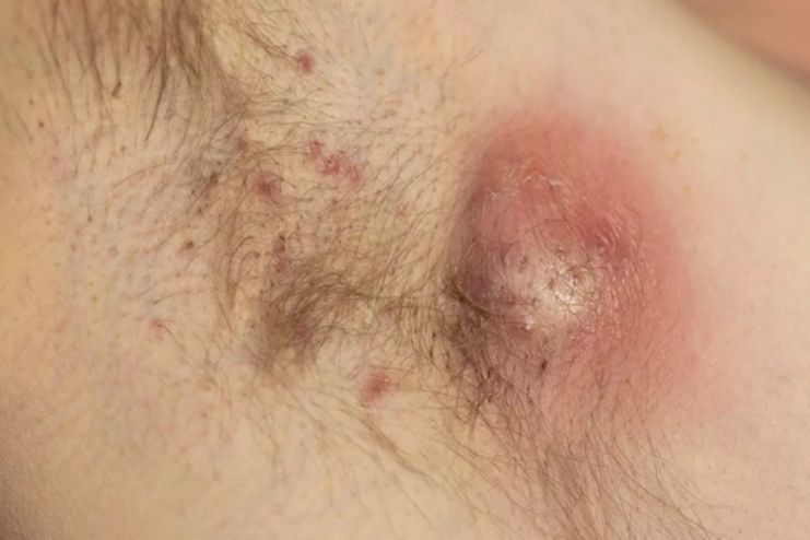 hidradenitis suppurativa - Complications